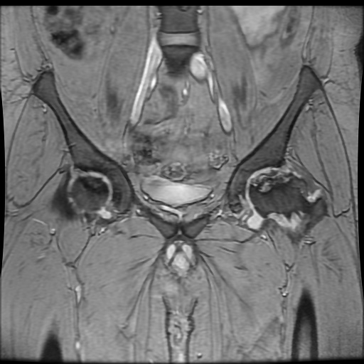 Avascular necrosis of the hip (Radiopaedia 61503-69465 F 33).jpg