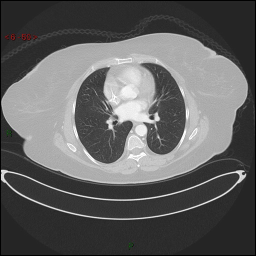 File:Azygos fissure and lobe (Radiopaedia 47620-52278 Axial lung window 50).jpg