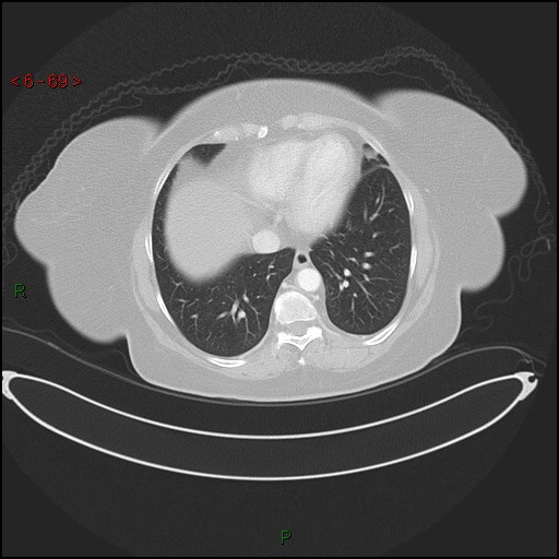 Azygos fissure and lobe (Radiopaedia 47620-52278 Axial lung window 69).jpg