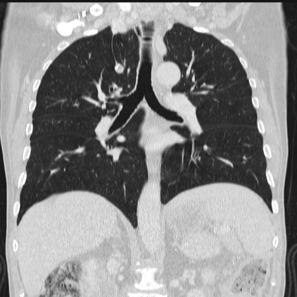 Azygos lobe (Radiopaedia 38259-40275 Coronal lung window 46).jpg