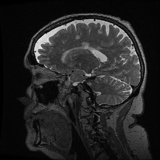 Balo concentric sclerosis (Radiopaedia 53875-59982 Sagittal 3D FSE 175).jpg
