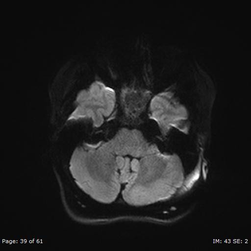 File:Balo concentric sclerosis (Radiopaedia 61637-69636 Axial DWI 39).jpg