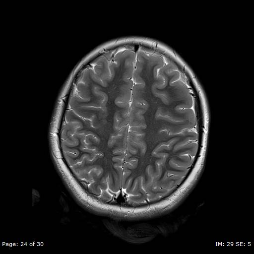 File:Balo concentric sclerosis (Radiopaedia 61637-69636 Axial T2 24).jpg