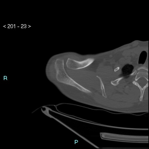 Bankart lesion with glenoid bone defect - assessment TC with PICO method (Radiopaedia 42855-93901 Axial bone window 22).jpg