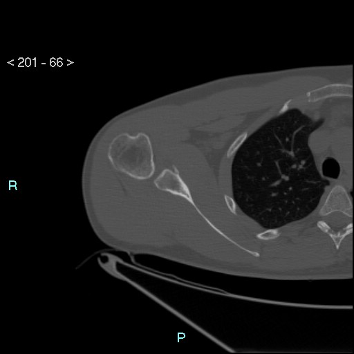 Bankart lesion with glenoid bone defect - assessment TC with PICO method (Radiopaedia 42855-93901 Axial bone window 65).jpg