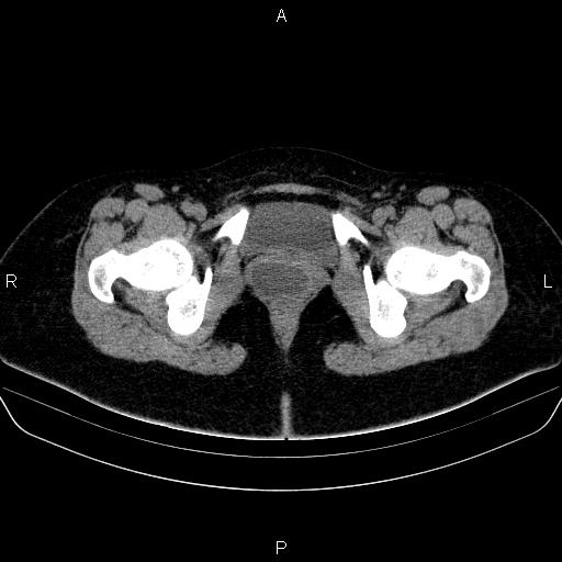 Bartholin gland cyst (Radiopaedia 62635-70930 Axial non-contrast 76).jpg