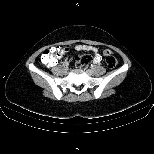 Bartholin gland cyst (Radiopaedia 62635-70930 C 18).jpg