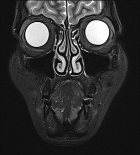 File:Basal cell carcinoma - nasal region (Radiopaedia 70292-80365 Coronal STIR 11).jpg