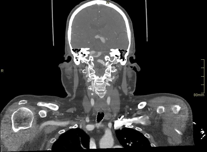 Basilar artery aneurysm (Radiopaedia 56261-62932 B 29).jpg