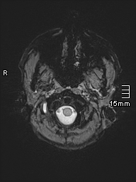Basilar artery perforator aneurysm (Radiopaedia 82455-99523 Axial SWI 1).jpg