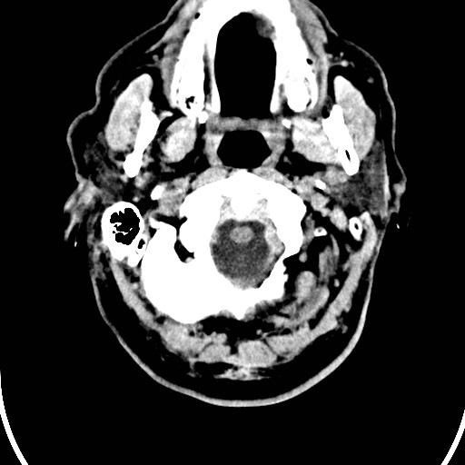 File:Basilar artery thrombosis (Radiopaedia 26986-27162 Axial non-contrast 1).jpg