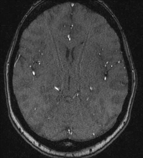 Basilar tip aneurysm (Radiopaedia 26504-26632 MRA 115).jpg