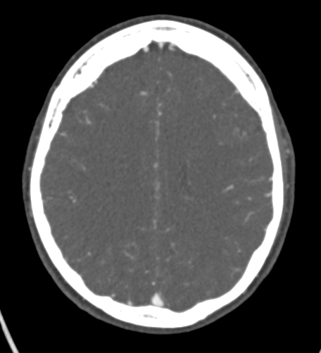 Basilar tip aneurysm with coiling (Radiopaedia 53912-60086 A 101).jpg