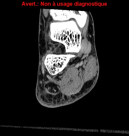 Baxter neuropathy (Radiopaedia 25988-26125 Coronal non-contrast 14).jpg