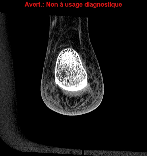 Baxter neuropathy (Radiopaedia 25988-26125 Coronal non-contrast 48).jpg