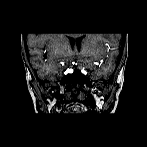 Berry aneurysm of the terminal internal carotid artery (Radiopaedia 88286-104918 Coronal TOF 32).jpg
