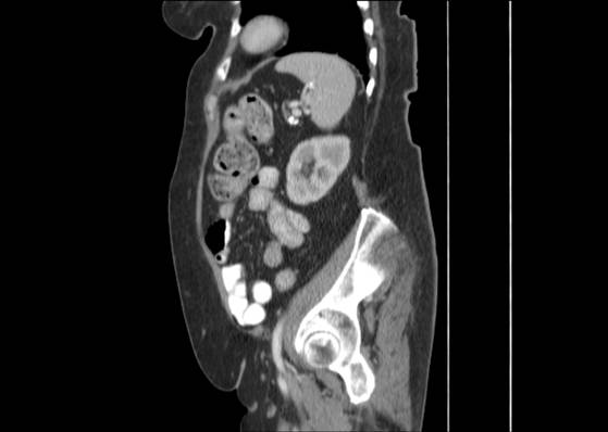 Bicameral celiacomesenteric aneurysm (Radiopaedia 55766-62327 B 43).jpg