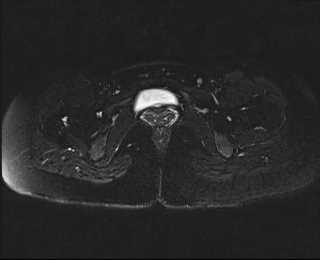 File:Bicornuate bicollis uterus (Radiopaedia 61626-69616 Axial PD fat sat 30).jpg