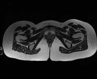 File:Bicornuate bicollis uterus (Radiopaedia 61626-69616 Axial T2 37).jpg