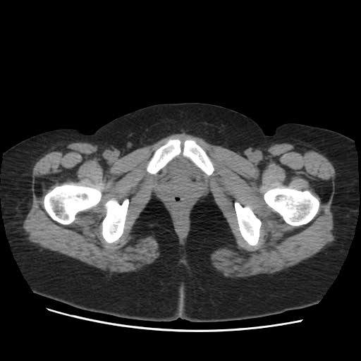 File:Bicornuate uterus- on MRI (Radiopaedia 49206-54296 Axial non-contrast 15).jpg