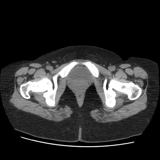 File:Bicornuate uterus (MRI) (Radiopaedia 49206-54296 Axial 6).jpg