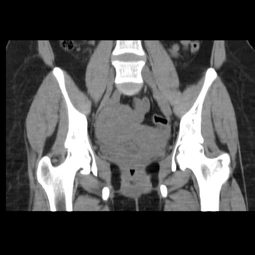File:Bicornuate uterus (MRI) (Radiopaedia 49206-54296 Coronal 1).jpg