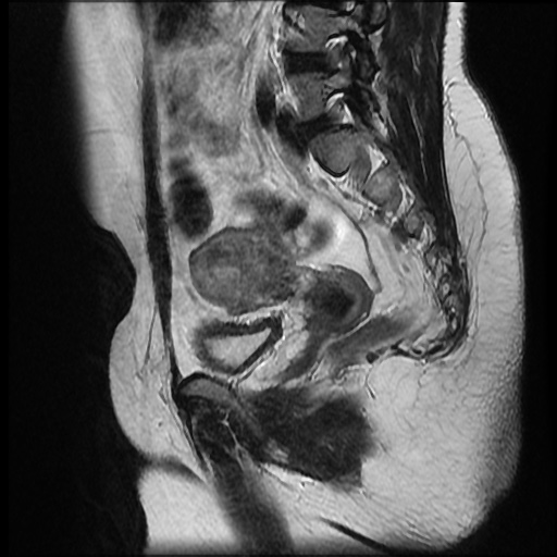 File:Bicornuate uterus (Radiopaedia 51676-57472 Sagittal T2 17).jpg