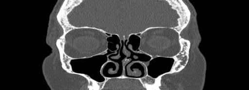 Bilateral Ectopic Infraorbital Nerves (Radiopaedia 49006-54084 Coronal bone window 26).jpg