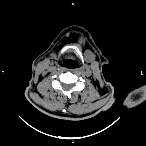 Bilateral Warthin tumors (Radiopaedia 84034-99263 Axial non-contrast 37).jpg