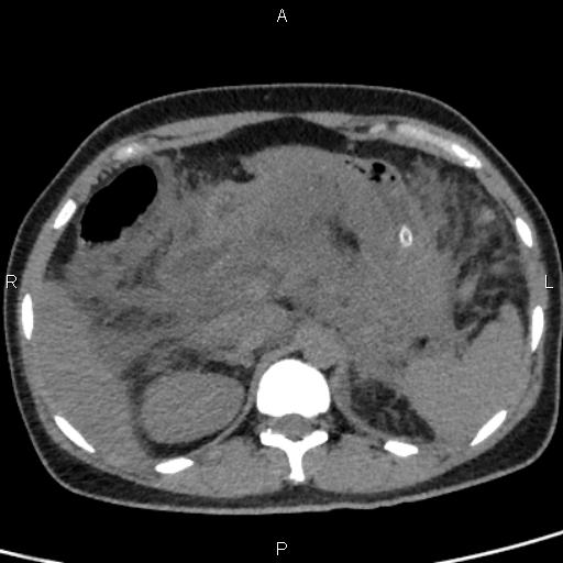 Bilateral adrenal gland hyperenhancement in pancreatitis (Radiopaedia 86642-102753 Axial non-contrast 33).jpg