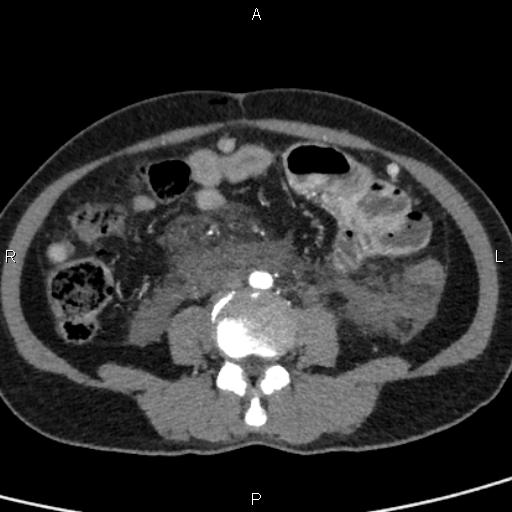 Bilateral adrenal gland hyperenhancement in pancreatitis (Radiopaedia 86642-102753 B 82).jpg