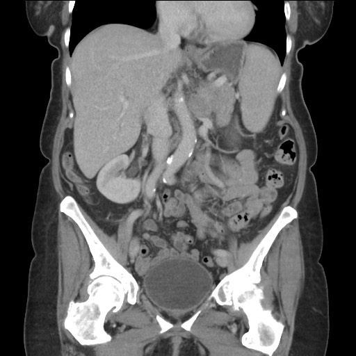 Bilateral adrenal granulocytic sarcomas (chloromas) (Radiopaedia 78375-91007 B 46).jpg