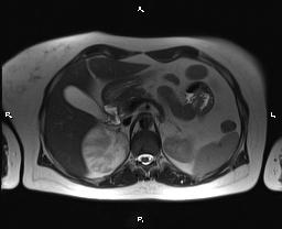 File:Bilateral adrenal myelolipoma (Radiopaedia 63058-71537 Axial T2 13).jpg