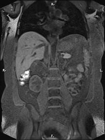 File:Bilateral adrenal myelolipoma (Radiopaedia 63058-71537 Coronal T1 fat sat 48).jpg