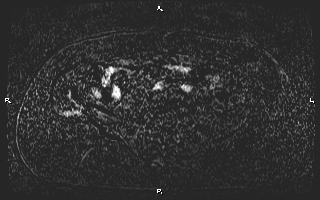 Bilateral adrenal myelolipoma (Radiopaedia 63058-71537 I 80).jpg