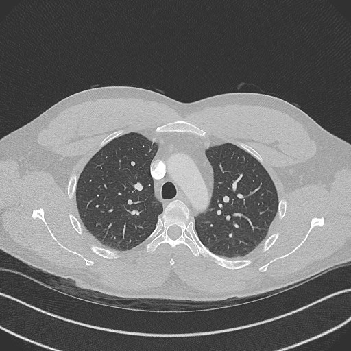 Bilateral atelectasis (Radiopaedia 48666-53675 Axial lung window 32).jpg