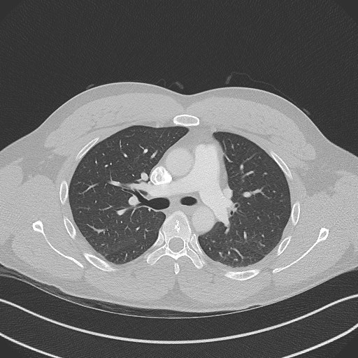 Bilateral atelectasis (Radiopaedia 48666-53675 Axial lung window 45).jpg