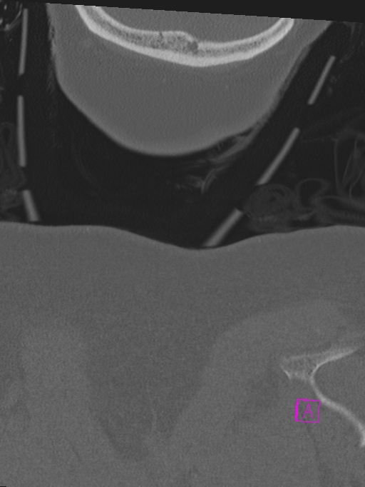 Bilateral atlanto-occipital assimilation (Radiopaedia 28350-28603 Coronal bone window 65).jpg