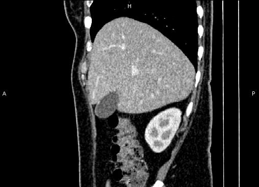 Bilateral benign adrenal adenomas (Radiopaedia 86912-103124 E 21).jpg