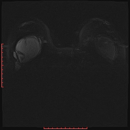 File:Bilateral breast implant rupture (Radiopaedia 24761-25027 PASTA Si IR 23).jpg