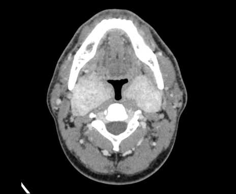 File:Bilateral carotid body tumors (Radiopaedia 61841-69870 Axial Post contrast 37).jpg