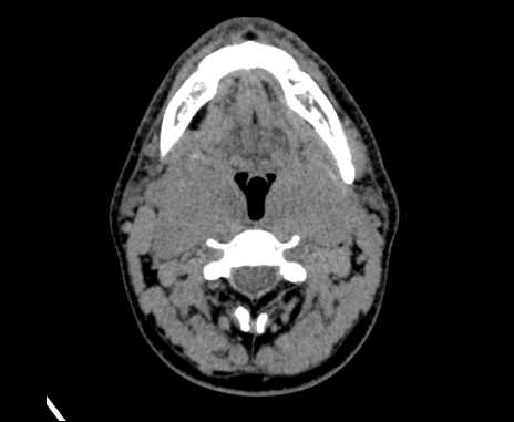 Bilateral carotid body tumors (Radiopaedia 61841-69870 Axial non-contrast 43).jpg