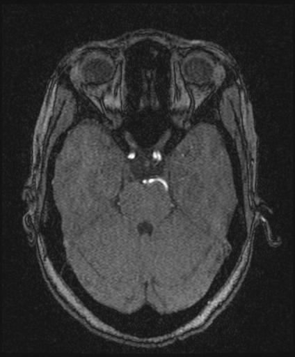 Bilateral carotid body tumors and right glomus jugulare tumor (Radiopaedia 20024-20060 Axial MRA 62).jpg
