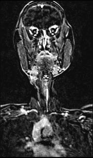 Bilateral carotid body tumors and right glomus jugulare tumor (Radiopaedia 20024-20060 MRA 79).jpg