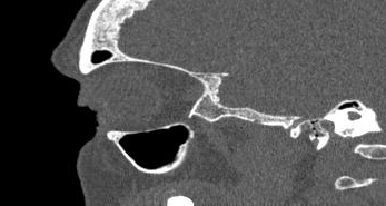 File:Bilateral ectopic infraorbital nerves (Radiopaedia 49006-54084 Sagittal 33).png