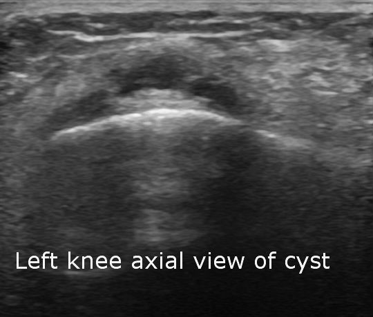 File:Bilateral lateral meniscal cysts (Radiopaedia 12200-12525 F 1).jpg