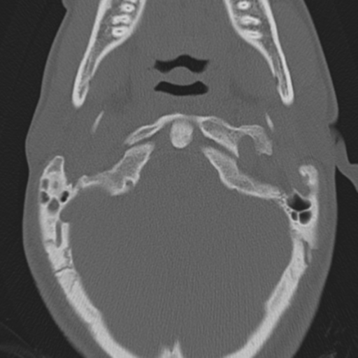 Bilateral locked facets (Radiopaedia 33850-35016 Axial bone window 4).png