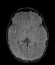 Bilateral mesial temporal polymicrogyria (Radiopaedia 76456-88181 Axial SWI 33).jpg