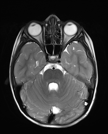 File:Bilateral mesial temporal polymicrogyria (Radiopaedia 76456-88181 Axial T2 7).jpg