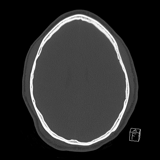 Bilateral occipital condyle fracture (type 2) (Radiopaedia 87675-104089 Axial bone window 89).jpg